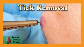 Dead Tick Removal  Auburn Medical Group [upl. by Eitsym]