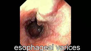 GI Bleeding An Overview  Los Angeles Colonoscopy [upl. by Della]