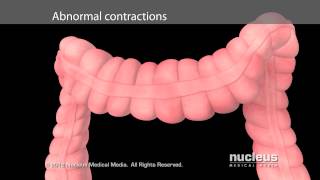 Irritable Bowel Syndrome IBS [upl. by Myna]