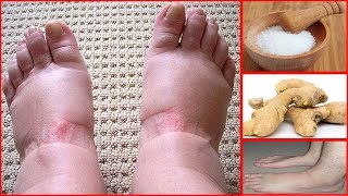 How To Cure Swollen Feet Naturally At Home [upl. by Ennoitna227]