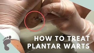 How To Treat Plantar Warts [upl. by Miett]