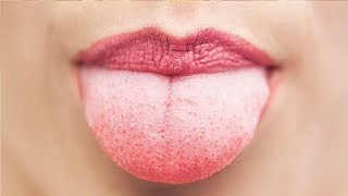 Easy Home Remedies to Get Rid of White Coated Tongue [upl. by Mercuri]