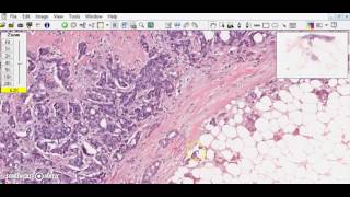 Breast ductal carcinoma Breast cancer [upl. by Enilrae]