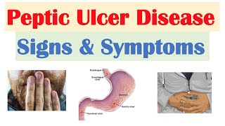 Peptic Ulcer Disease Signs amp Symptoms  Gastric vs Duodenal Ulcers [upl. by Hannasus909]