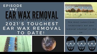 2021s TOUGHEST EAR WAX REMOVAL TO DATE  EP442 [upl. by Pavkovic242]