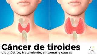 CÁNCER DE TIROIDES diagnóstico tratamiento síntomas causas [upl. by Hplodnar]