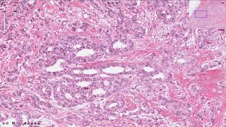 Ductal Carcinoma  Breast [upl. by Assirol]