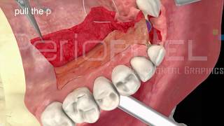 Vídeo 3D Técnica del Injerto Palatino Pediculado  PerioPixel [upl. by Samale]