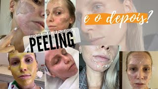 PEELING ANTES E DEPOIS  Bruna Harmel [upl. by Aidroc]