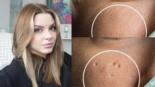 Esthetician Discusses How To Eliminate Pitted Acne Scars [upl. by Reo42]