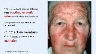 Dermatology wk5Win21 Actinic Keratosis [upl. by Nelrac]