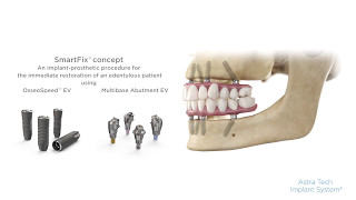 Stepbystep procedure SmartFix® concept for Astra Tech Implant System® EV  Dentsply Sirona [upl. by Goldshell]