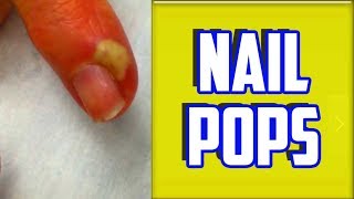 Top 4 Paronychia amp Nail Infections of All Time [upl. by Eibloc870]