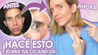 COMO BORRÉ MIS CICATRICES DE ACNE  Recomendaciones de un dermatólogo  Simon Scarano [upl. by Humble585]