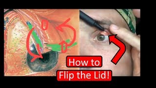 Flipping the Eyelid  MADE EASY [upl. by Vudimir]