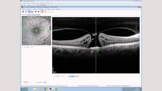 Case Study with SPECTRALIS OCT Macular Hole [upl. by Atinid]