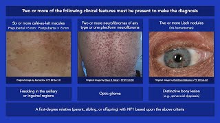 What is Neurofibromatosis Type 1 NF1 [upl. by Merari]