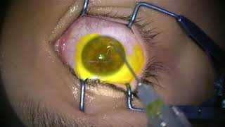 Corneal Collagen Cross Linking for Keratoconus [upl. by Ocir]