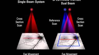 SPECTRALIS OCT TruTrack Aktives Eye Tracking [upl. by Cooperman]