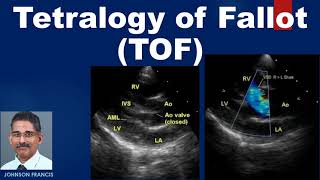 Tetralogy of Fallot TOF [upl. by Lennod572]