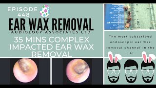 35 MINS COMPLEX IMPACTED EAR WAX REMOVAL  EP449 [upl. by Nosnaj349]