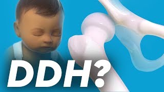 Developmental Dysplasia of the Hip DDH in English accent from USA [upl. by Isadora]