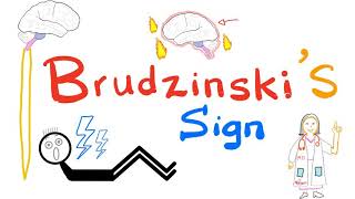 Brudzinskis Sign  Meningitis  Neurology  Physical Exam [upl. by Ciaphus661]