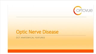 OCT Interpretation Session 8 Optic Nerve Disease [upl. by Carline897]