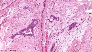 Fibroadenoma  Histopathology [upl. by Nerin]