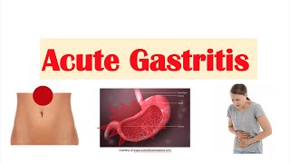 Acute Gastritis Stomach Inflammation  Causes Signs amp Symptoms Diagnosis Treatment [upl. by Mays]