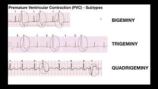 EKG Patterns  Premature Atrial amp Ventricular Contractions PACs amp PVCs [upl. by Aihsenad500]