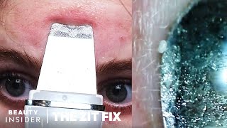 Pore Spatula Blackhead Extractions Under A Microscope  The Zit Fix [upl. by Feinberg]