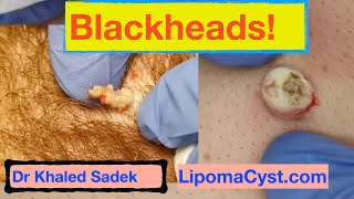 Dr Khaled Sadek Blackhead Compilation LipomaCystcom [upl. by Lorry813]