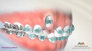 Orthodontic Treatment for Impacted Canine  Laser Exposure [upl. by Marijane541]