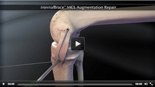 InternalBrace™ MCL Augmentation Repair [upl. by Birdt]