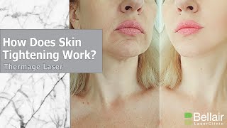 What is Thermage skin tightening [upl. by Savil]