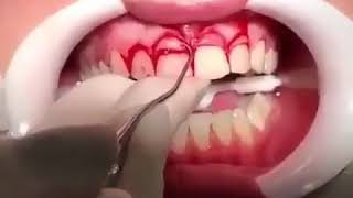 Gingivectomy amp Crown lengthening [upl. by Yenroc]