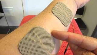 TENS  Where to apply the electrodes on forearm as example [upl. by Jamilla]