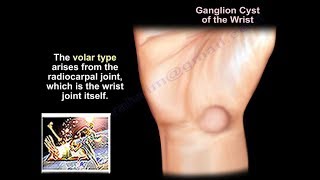 Ganglion Cyst Wrist  Everything You Need To Know  Dr Nabil Ebraheim [upl. by Karry]