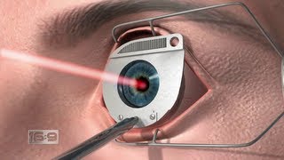 16x9  2020 Hindsight Laser eye surgery investigation [upl. by Diad378]