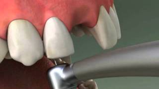 Dentist  Maryland Bridge Procedure [upl. by Servais1]