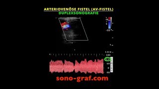 Duplexsonografie  Arteriovenöse Fistel AVFistel 1 [upl. by Keithley47]