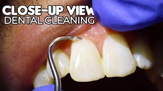 Dental Cleaning  CloseUp View ASMR [upl. by Mariandi]