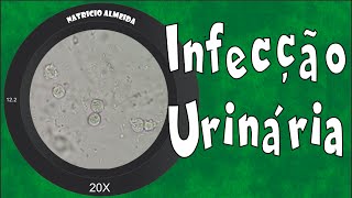 Infecção urinária  Piúria bactérias e muco [upl. by Brote]