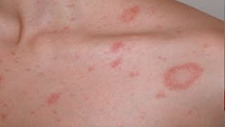 Pityriasis rosea English version [upl. by Wallinga]