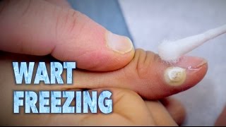 FREEZING WARTS With Sizzling Liquid Nitrogen  Dr Paul [upl. by Horne347]