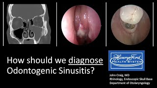 Diagnosing Odontogenic Sinusitis International Consensus [upl. by Rodama]