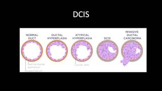 Breast Cancer Review Series DCIS and IDC [upl. by Olivie653]