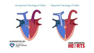 Tetralogy of Fallot [upl. by Tobye]