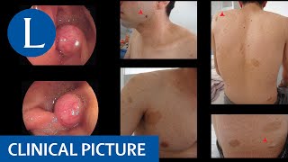 Plexiform Neurofibroma in Neurofibromatosis1 NF1 5Minute Pathology Pearls [upl. by Alamac]